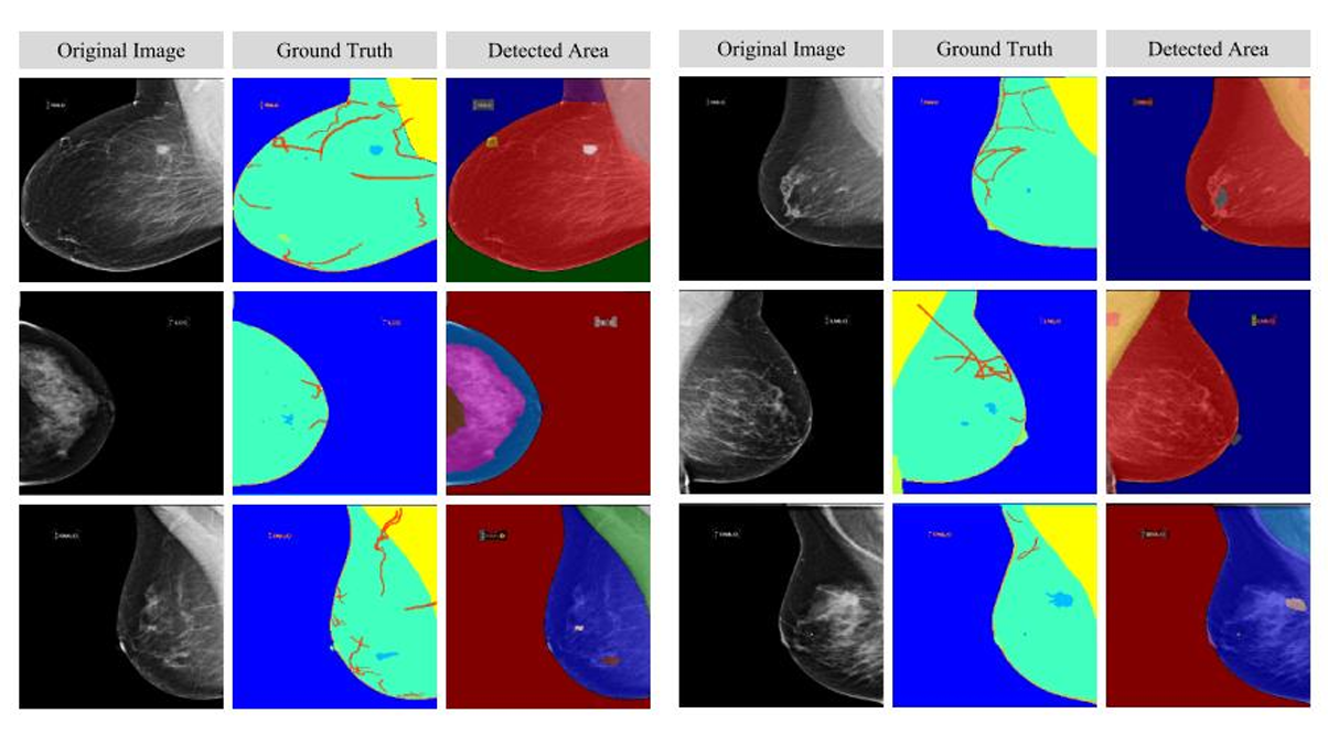 Breast tumor segmentation comparison between Segment Anything Model and U-Net