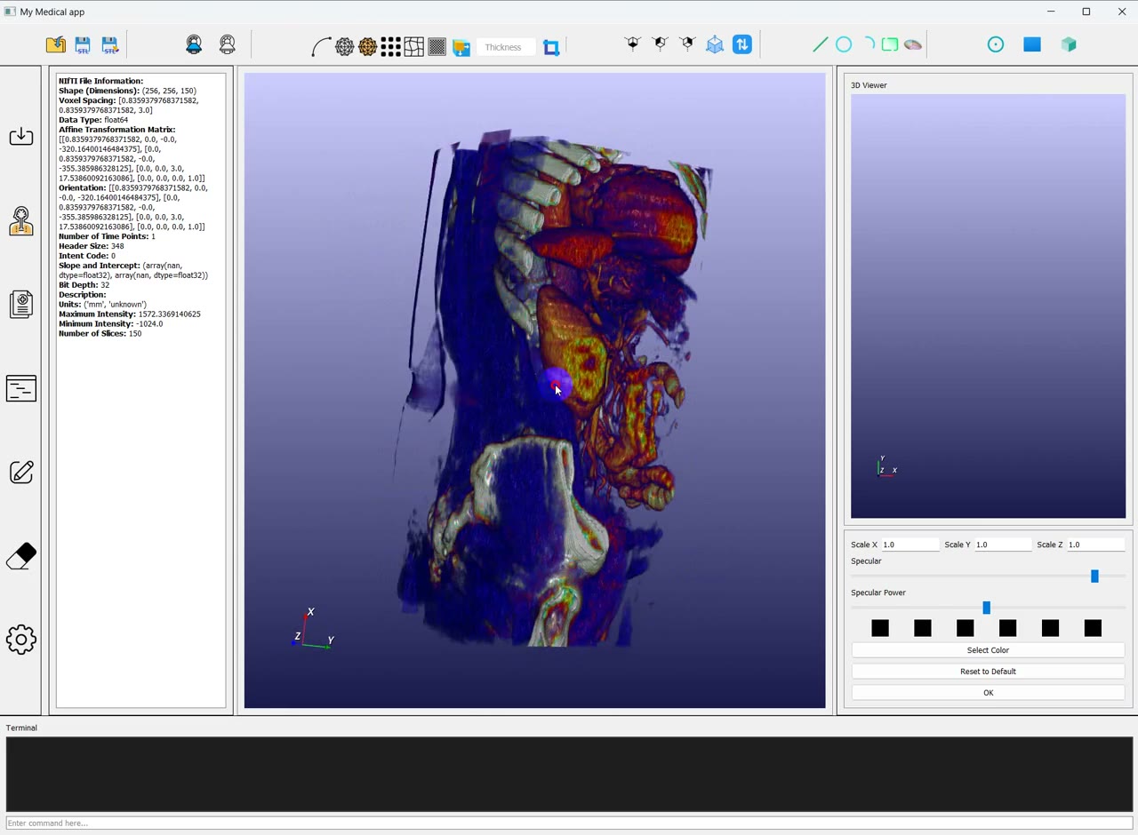 Nodal load definition on a meshed lumbar vertebra